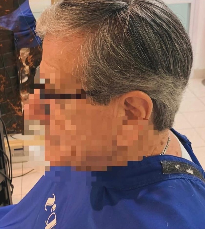 Después: prótesis capilar indetectable
